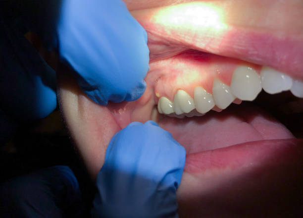 Best Broken Tooth Emergency  in North Bend, WA
